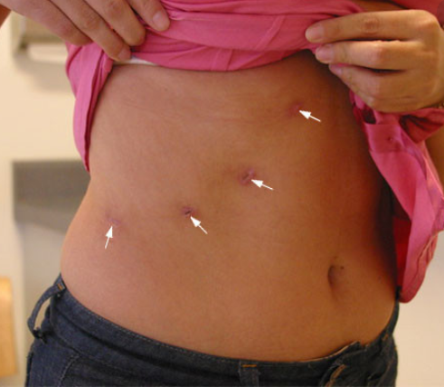 surgery scars